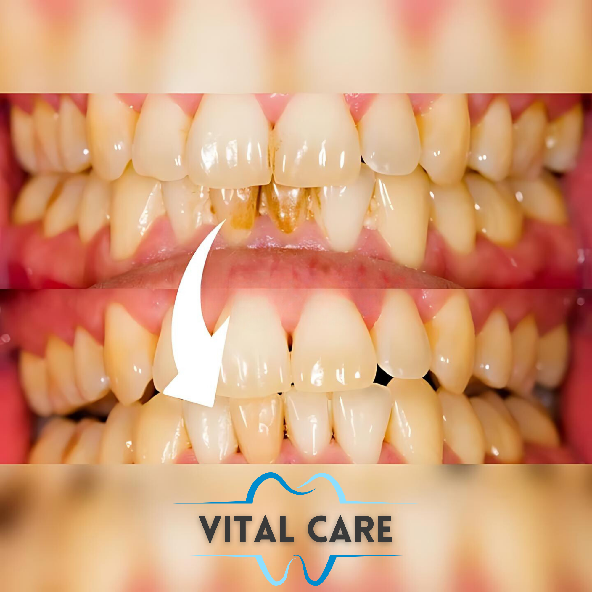 VITAL CARE | Kit dentaire ultime 2 en 1 : Blanchiment et nettoyage efficaces