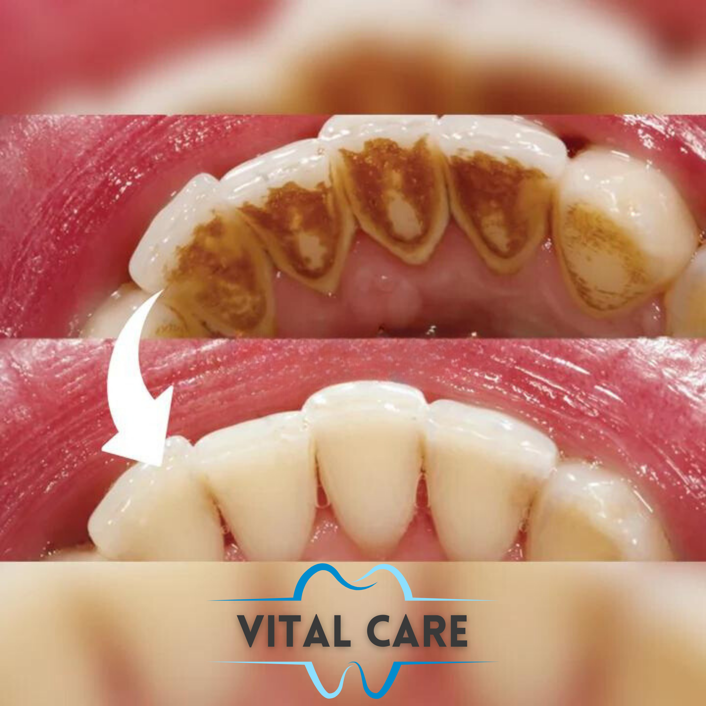 VITAL CARE | Jet dentaire : Un blanchiment et un nettoyage efficaces