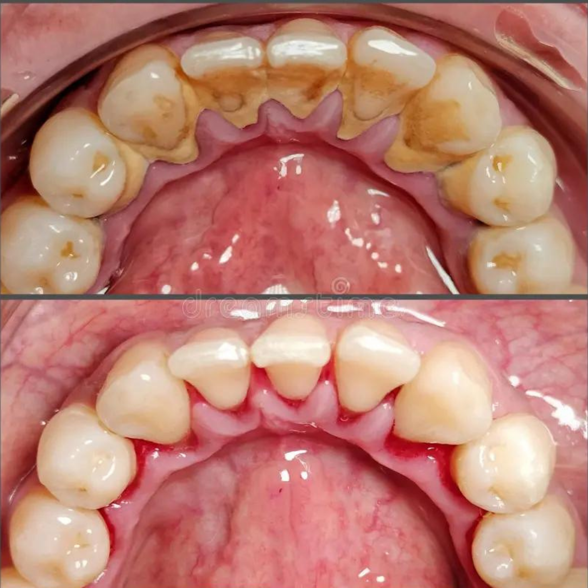 VITAL CARE | Kit dentaire ultime 2 en 1 : Blanchiment et nettoyage efficaces