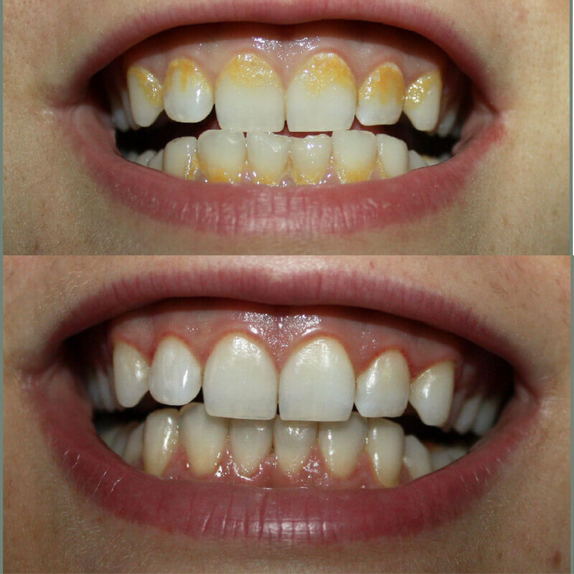 VITAL CARE | Kit dentaire ultime 2 en 1 : Blanchiment et nettoyage efficaces