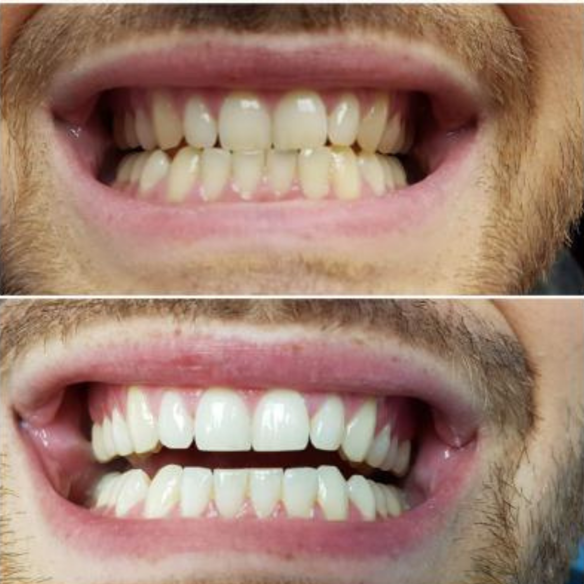 VITAL CARE | Kit dentaire ultime 2 en 1 : Blanchiment et nettoyage efficaces