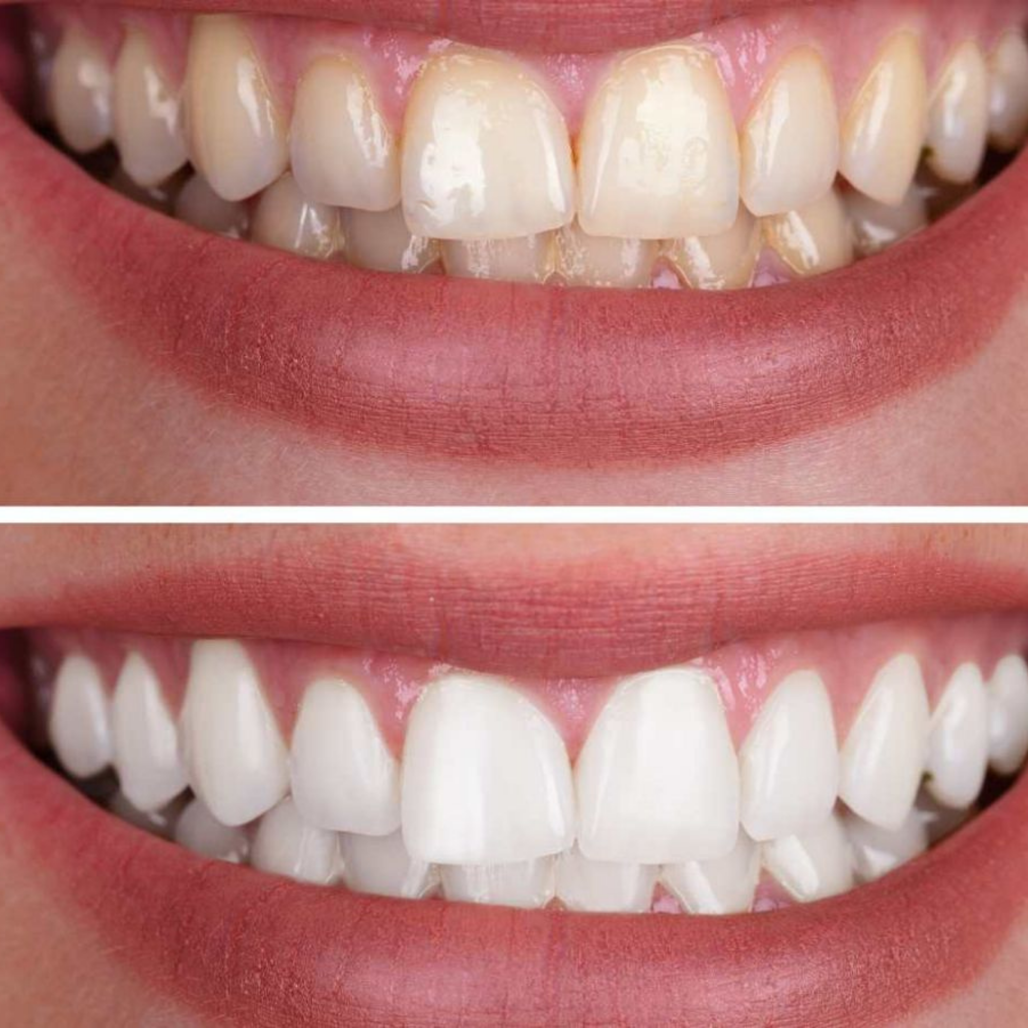 VITAL CARE | Kit dentaire ultime 2 en 1 : Blanchiment et nettoyage efficaces