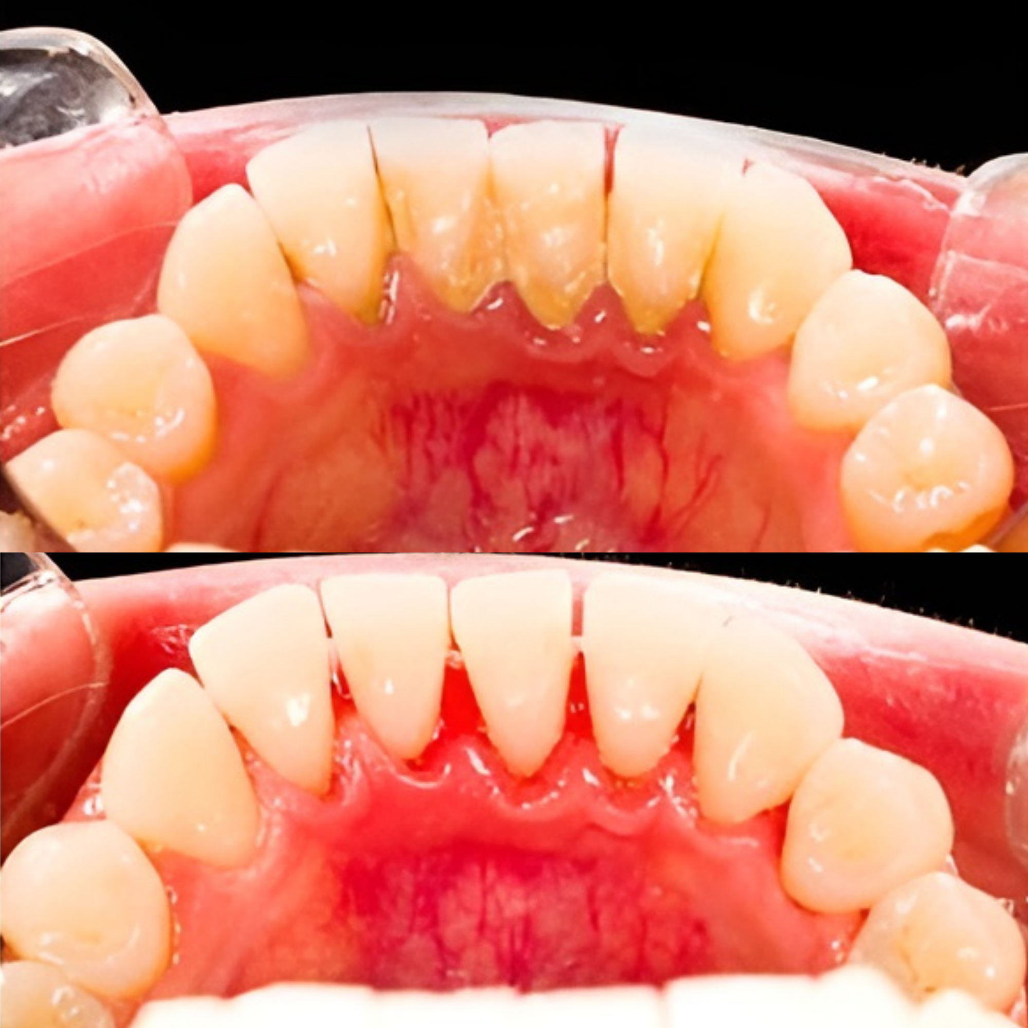 VITAL CARE | Jet dentaire : Un blanchiment et un nettoyage efficaces