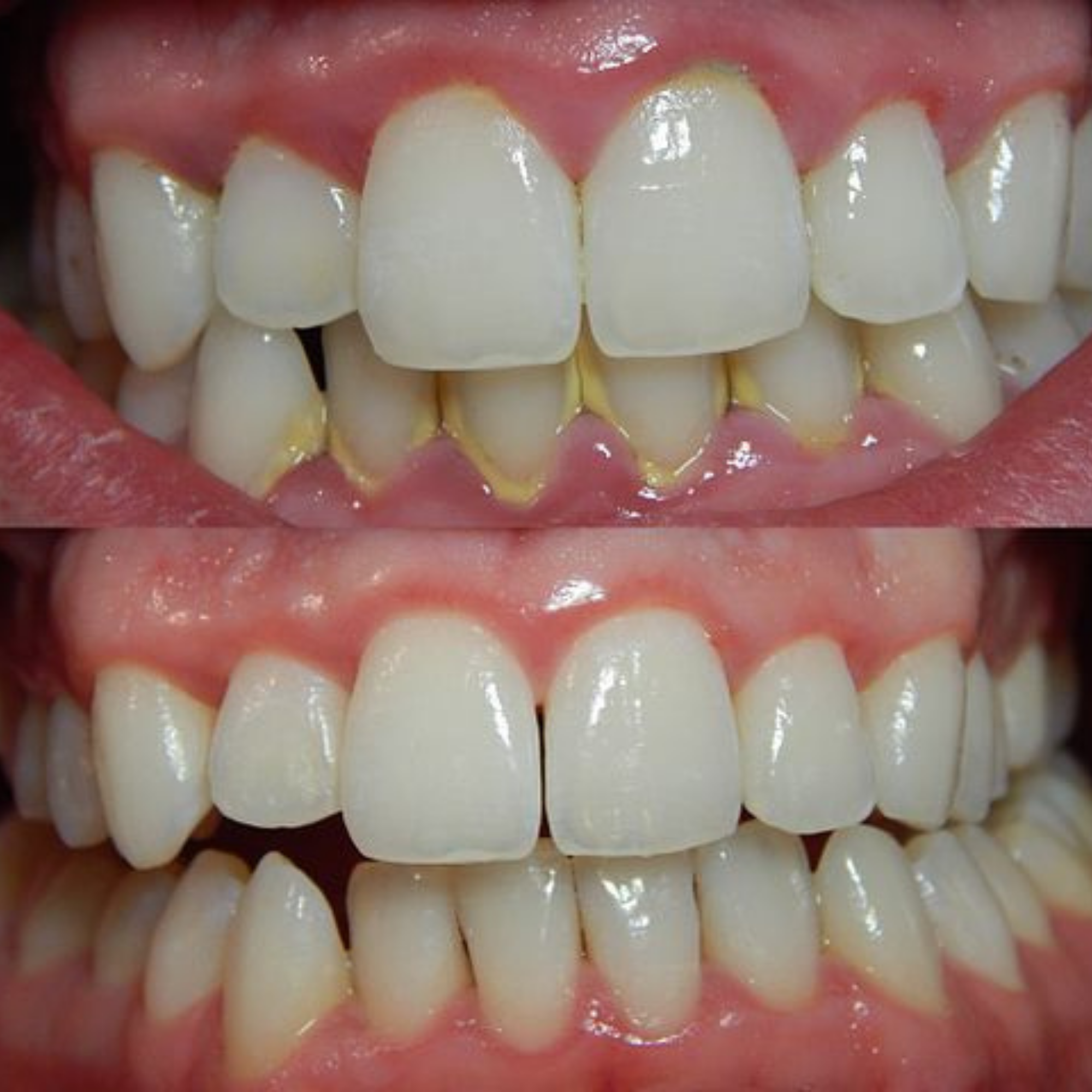 VITAL CARE | Kit dentaire ultime 2 en 1 : Blanchiment et nettoyage efficaces