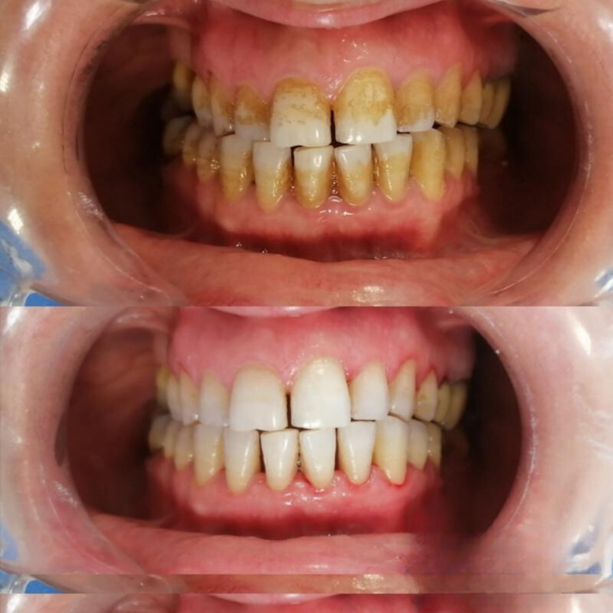 VITAL CARE | Kit dentaire ultime 2 en 1 : Blanchiment et nettoyage efficaces